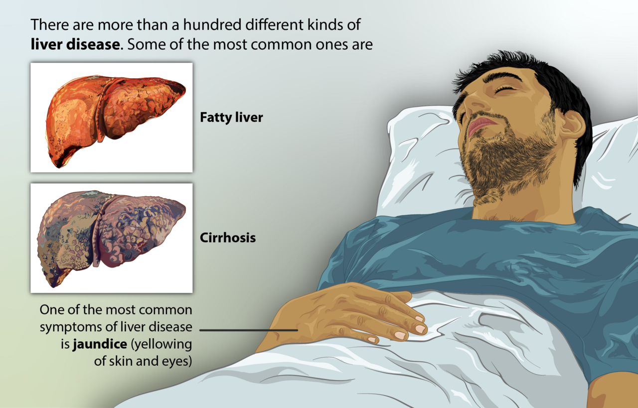Depiction of a person suffering from LIVER DISEASE. The common types of liver disease have been shown.