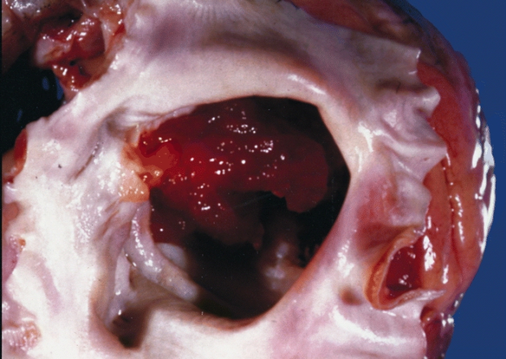 "HEART-GREAT VESSELS: CARDIAC MYXOMA